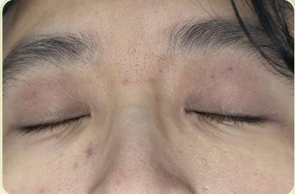 濕疹治療後，眼瞼