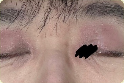 濕疹治療前，眼瞼