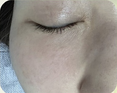 濕疹治療後，面頰