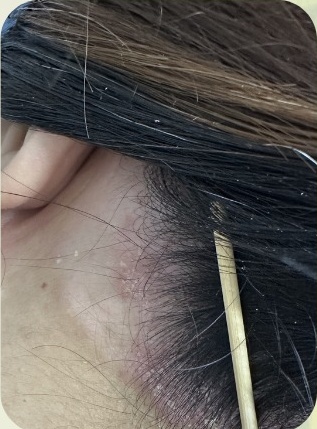 銀屑病治療後，耳側髮際